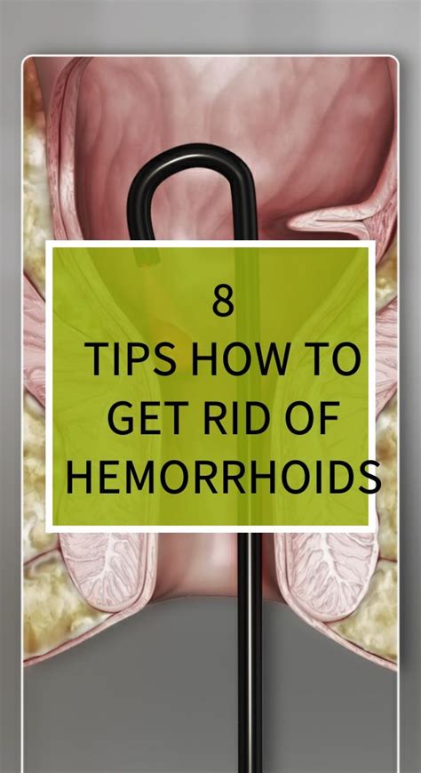 8 Tips How To Get Rid Of Hemorrhoids Natural Cold Remedies