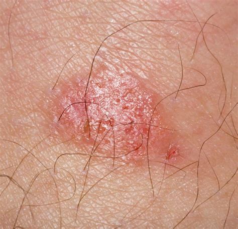 Causes Of Rash On Inner Thigh And Treatment Charlies Magazines