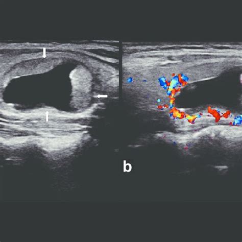 Benign Thyroid Nodule With Large Intratumoral Cyst Transverse