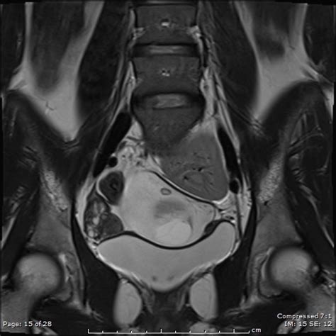 Ovarian Torsion Mayer Rokitansky Küster Hauser Syndrome Image