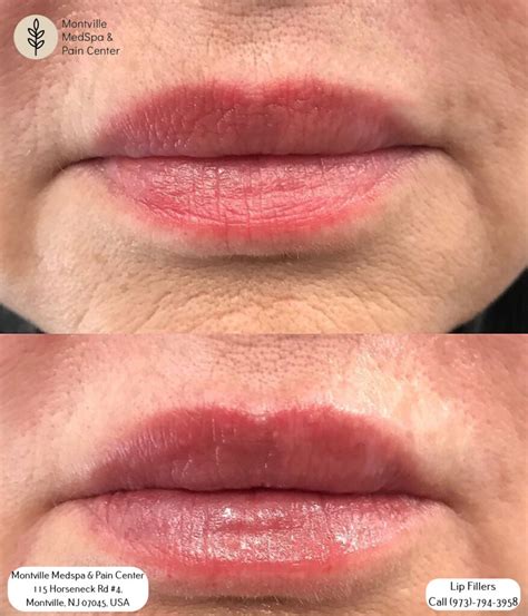 How To Reduce Swelling After Lip Filler