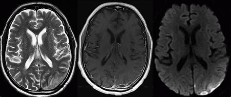 Brain Infections Radiology Key