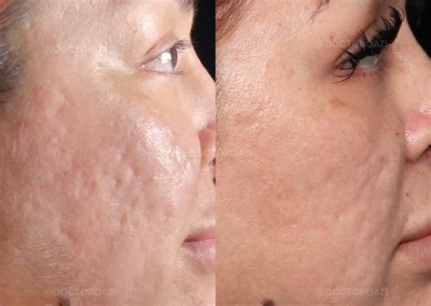 acne scars treatment newport beach qazi cosmetic center