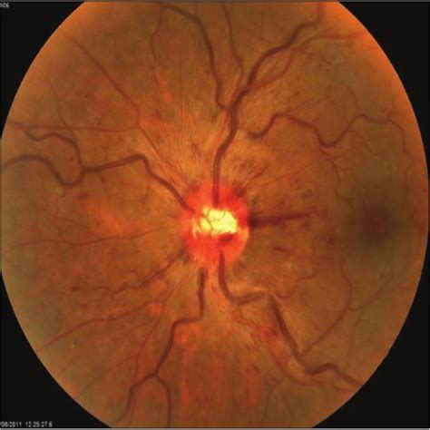 Color Fundus Photograph Of The Left Eye Revealed Superficial