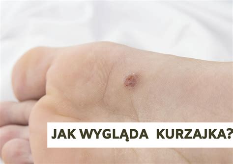 Jak Wygląda Kurzajka Codziennypl