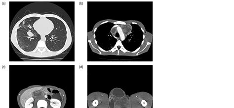 A Multiple Lung Metastases B Mediastinal Lymph Node Metastasis
