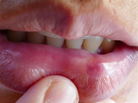 Bumps Inside Lips Causes Small Clear White Or Red Bumps Treatments