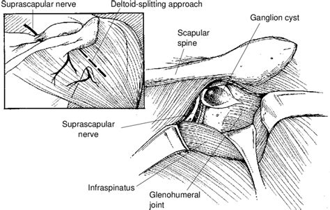 Posterior Approach To The Suprascapular Nerve At The Spinoglenoid Notch