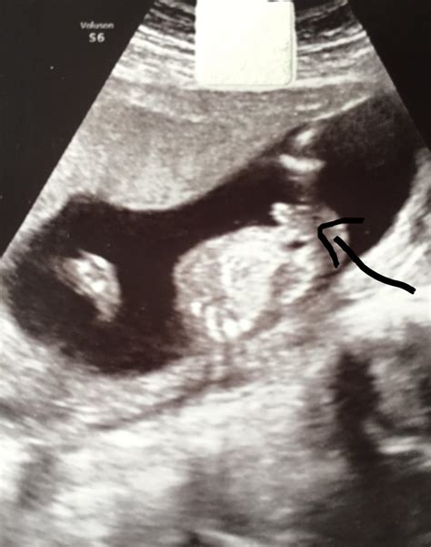 ultraschall 15 0 junge oder mädchen forum schwangerschaft urbia de