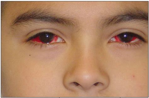 Case In Point Subconjunctival Hemorrhages In A Teenage Boy Consultant360