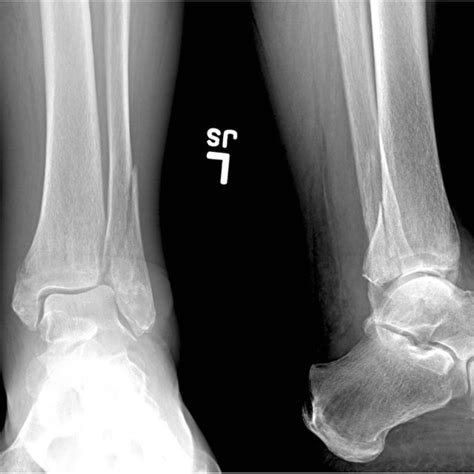 A Seemingly Innocuous Non Displaced Weber B Distal Fibula Fracture In A