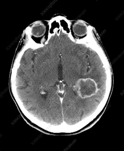 Glioblastoma Ct Scan Stock Image C0372972 Science Photo Library