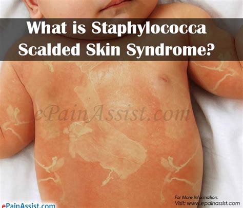 What Is Staphylococcal Scalded Skin Syndromecausessymptomstreatment