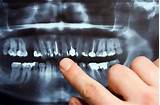 Images of Emergency Wisdom Tooth Extraction Nyc