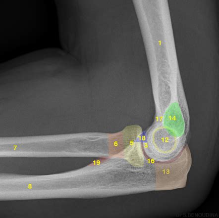 Elbow Radiology Reference Article Radiopaedia Org