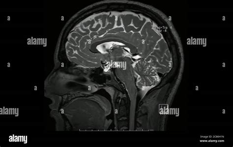 Magnetic Resonance Images Of The Brain Mri Brain Sagittal T2 Weighted