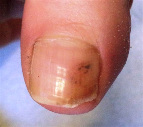 Skin Cancer Under Toenail