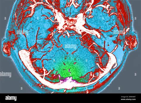 Trombosis De Los Senos Venosos Cerebrales De La Duramadre Visualizada