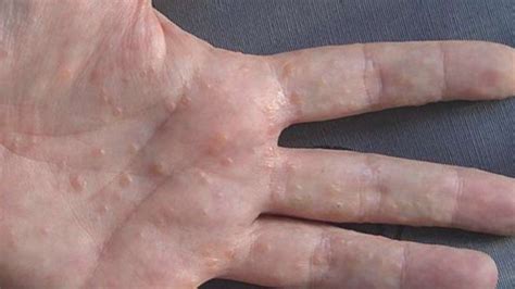 Dyshidrotic Eczema Symptoms Prevention And Treatment Greenbhl