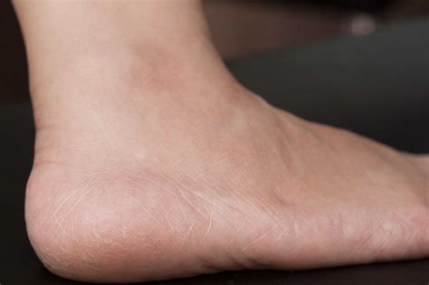 Home Remedies For Extremely Dry Feet