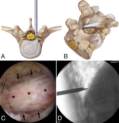 Full Endoscopic Uniportal Decompression In Disc Herniations And Stenosis Of The Thoracic Spine