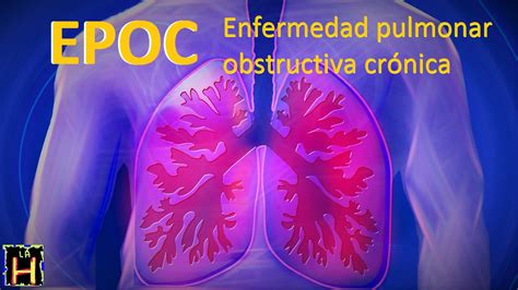Epoc Enfermedad Pulmonar Obstructuva Cronica Sintomas Factores Riesgo