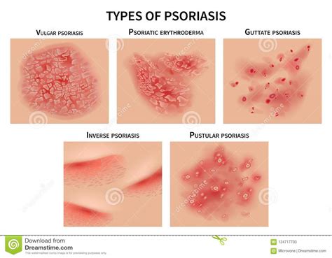 Psoriasis Types Skin Hives Derma Diseases Closeup Medical Vector