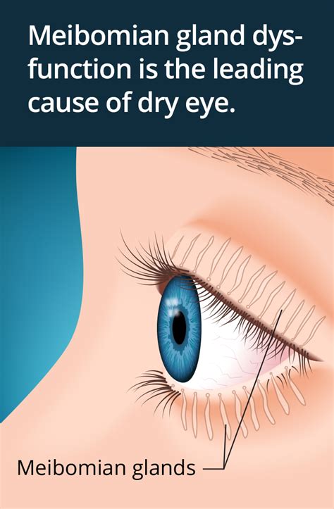What You Should Know About Meibomian Gland Dysfunction Mgd Dry Eye