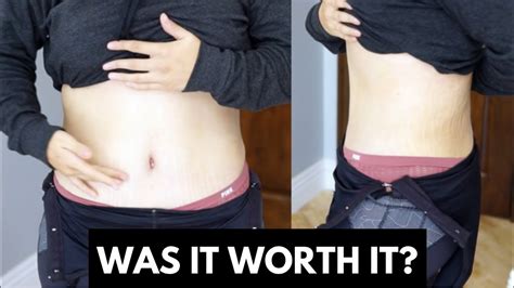 Honest Review On My Tummy Tuck Plastic Surgery Update Youtube