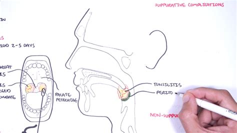 Strep Throat Streptococcal Pharyngitis Pathophysciology Signs And