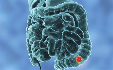 Blood Test For Colon Cancer The Biomedical Scientist Magazine Of The
