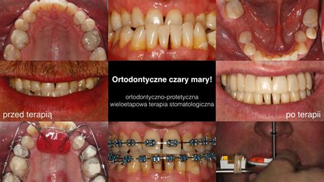 Ortodontyczno Protetyczna Wieloetapowa Terapia Stomatologiczna YouTube