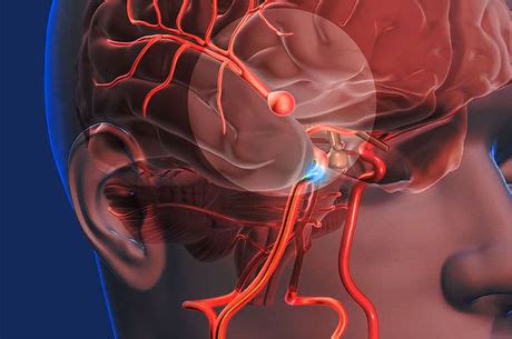 Un aneurisma cerebral (también llamado aneurisma intracraneal o aneurisma cerebral) es un área protuberante y debilitada en la pared de una arteria en el cerebro, que produce ensanchamiento o distensión anormal. Aneurisma Cerebral