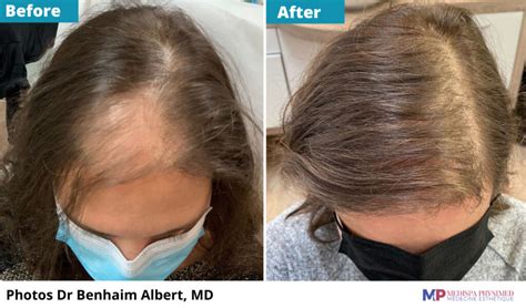 Prp For Hair Loss Womens Aesthetics Medispa Physimed