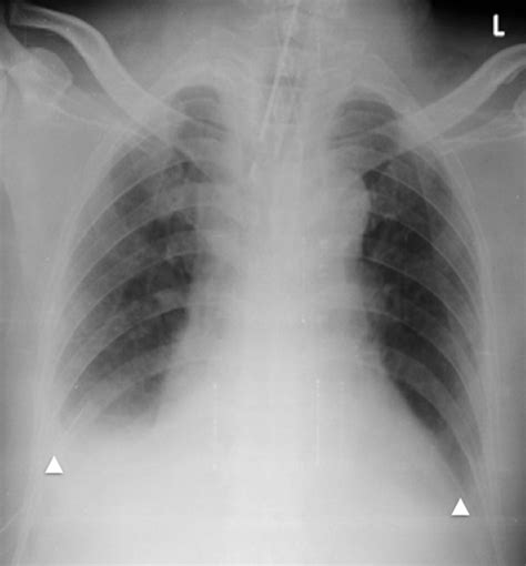 Unusual Case Of Retrosternal Chest Pain A Twist In The Tale Bmj Case