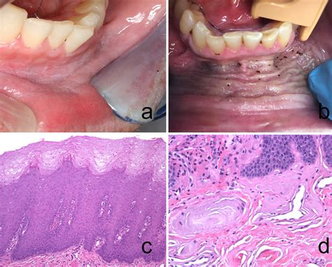 A Typical Clinical Presentation Of An Early Smokeless Tobacco Keratosis