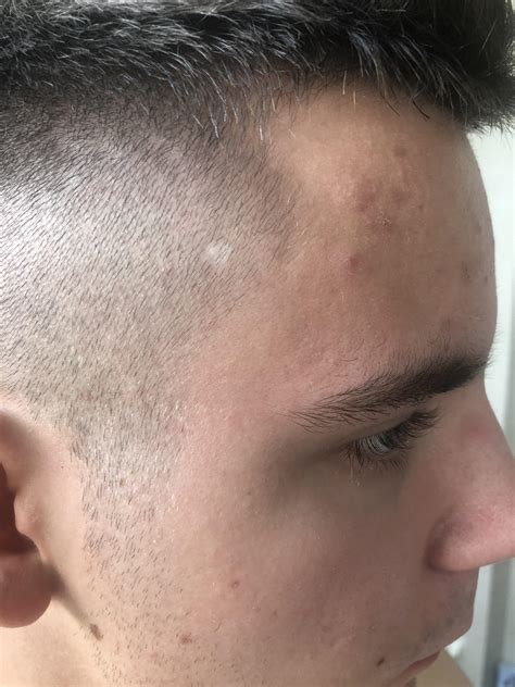 I Noticed White “mole” On My Scalp When I Got Short Haircut What It