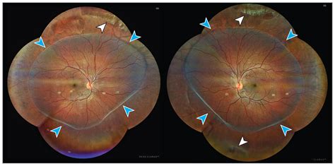 Hypoplasic Vitreous In Stickler Syndrome Ophthalmology Jama
