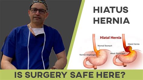How Safe Is Surgery For Hiatus Hernia Repair Youtube