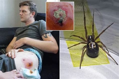 Best Ideas For Coloring Black Widow Spider Bite