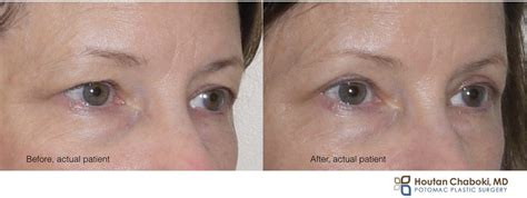 Cosmetic Upper Eyelid Surgery May Modify Skin Muscle Andor Fat