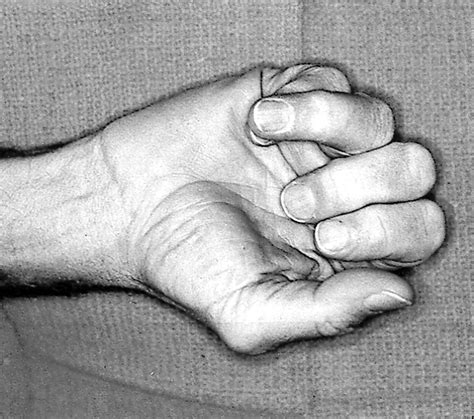 Metacarpal Fractures Hand Orthobullets
