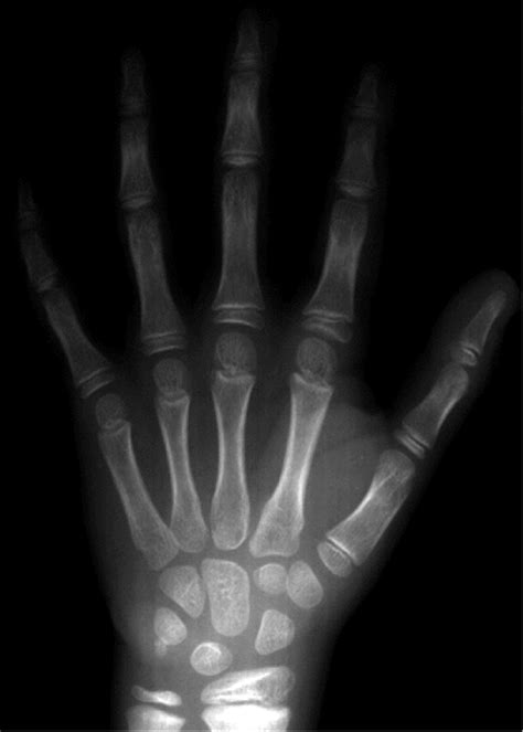 Bone Of Contention Can Wrist X Rays Really Reveal The Age