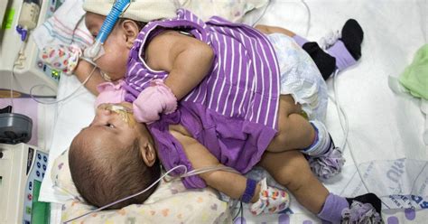 Hope Faith Strong For Mother Of Conjoined Texas Twins
