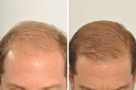 Hair Restoration For Men Dr David Rosenberg