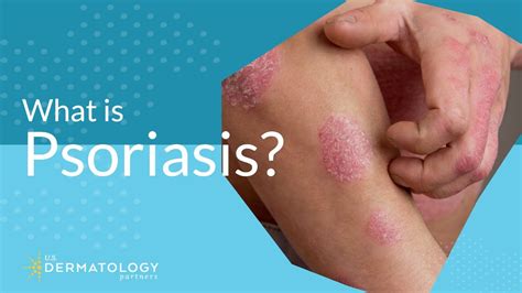 What Is Psoriasis Youtube