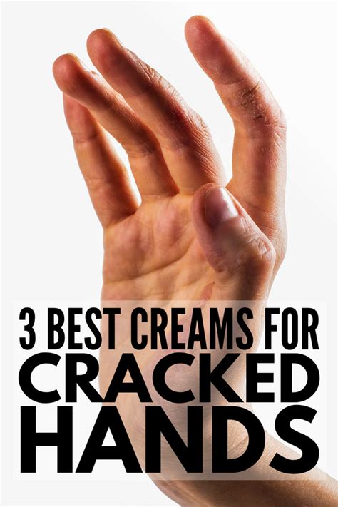 severely cracked hands 8 tips and remedies for fast relief cracked hands dry cracked hands
