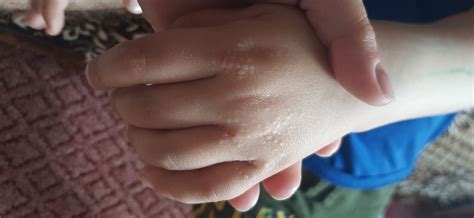 Сыпь на руках у ребёнка Вопрос детскому дерматологу 03 Онлайн