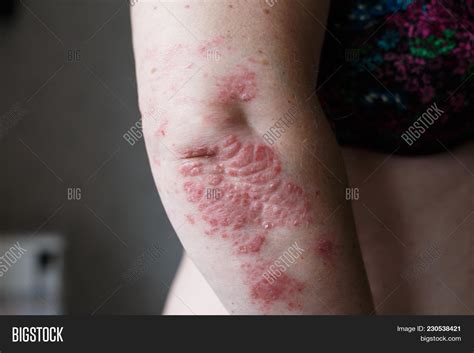 Psoriasis Skin Image And Photo Free Trial Bigstock