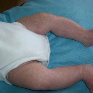 The nerve supply that is used to the fine blood vessels especially on the upper skin layer is still very much immature. Neonatal Problems & ALTE — #EM3: East Midlands Emergency ...